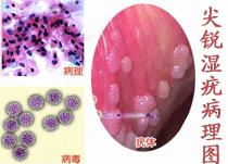 庐江妇产医院 妇科 性病 尖锐湿疣【导语】女性得了性病后临床症状不